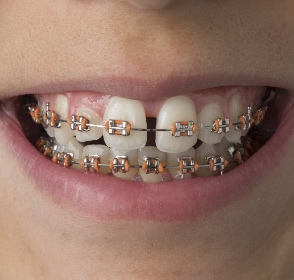 Close up of child smiling with braces for Phase 1 orthodontic treatment in Prosper