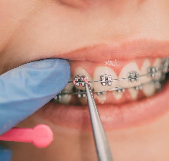 Close up of orthodontist adjusting the elastic bands on a patient with braces