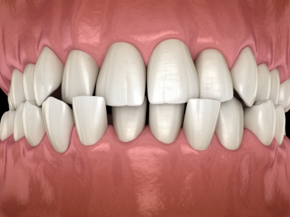 Illustrated close up of misaligned teeth