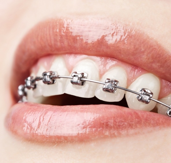 Close up of smile with metal braces