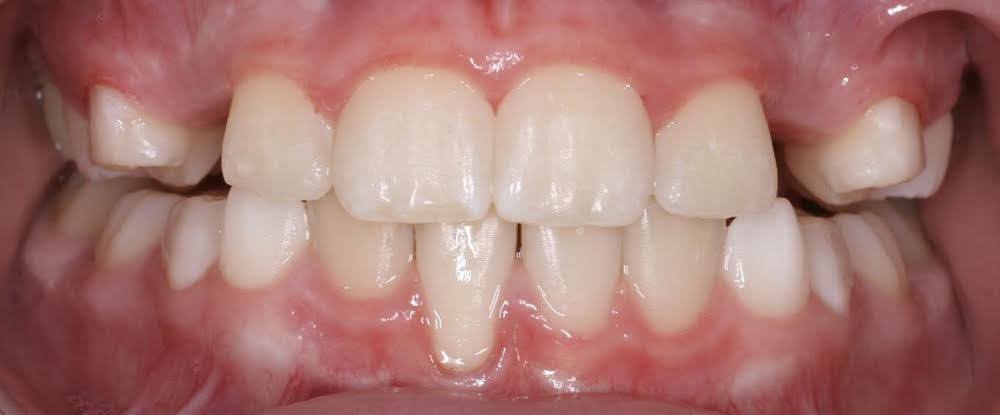 Close up of mouth with well aligned teeth