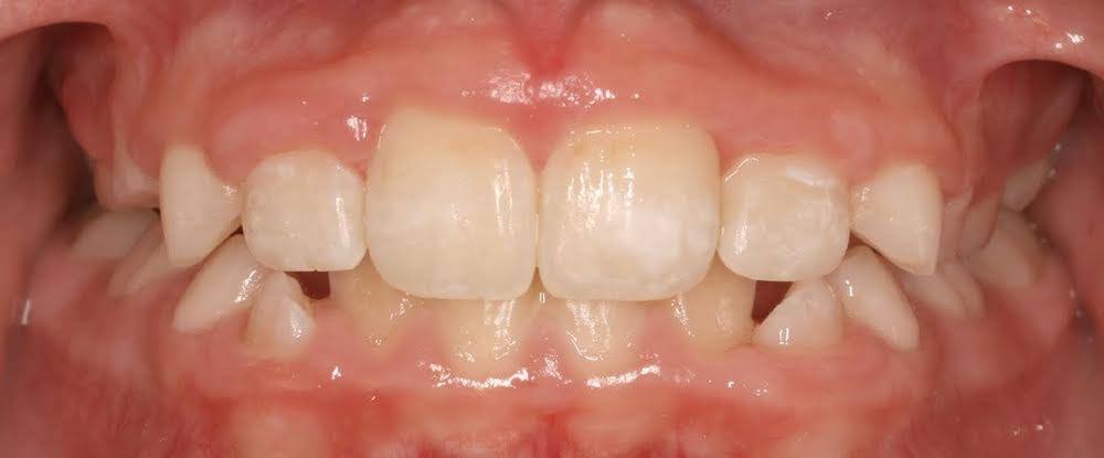 Close up of mouth after treating gapped teeth