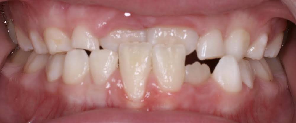 Close up of mouth with misaligned teeth