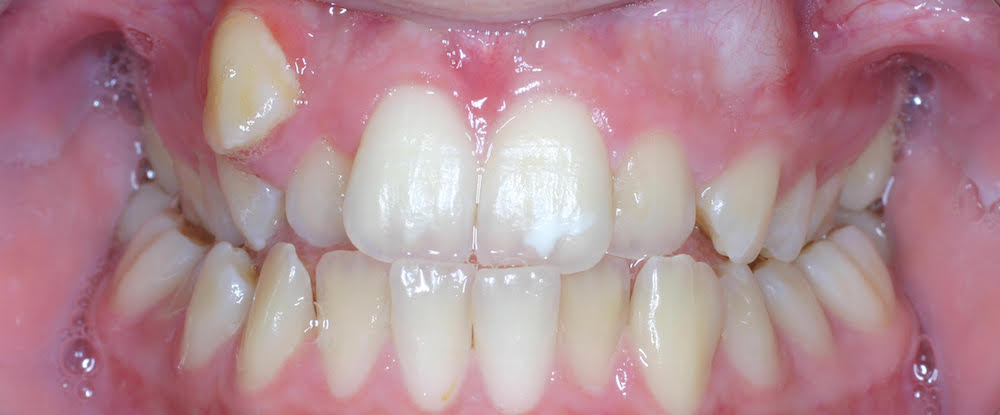 Closeup of smile with crossbite impacted canines and crowding