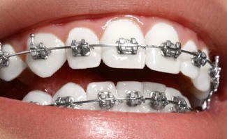 Close up of smile with metal braces in Prosper