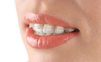 Close up of person with clear braces on their teeth
